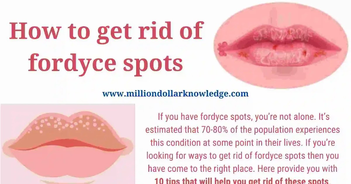 How To Get Rid Of Fordyce Spots 10 Best Remedies For Fordyce Spots
